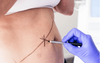 Don't have a lot of fat CoolSculpting still works