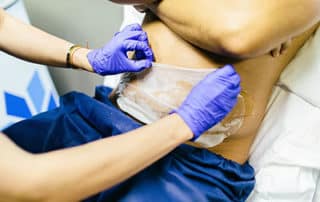 Is CoolSculpting cheating procedure being done