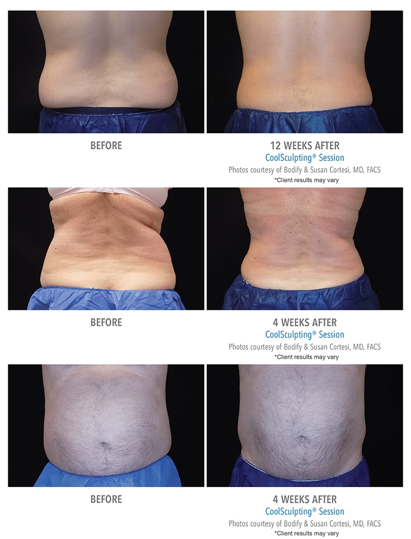 CoolSculpting Before After Photos Client Results Bodify Arizona