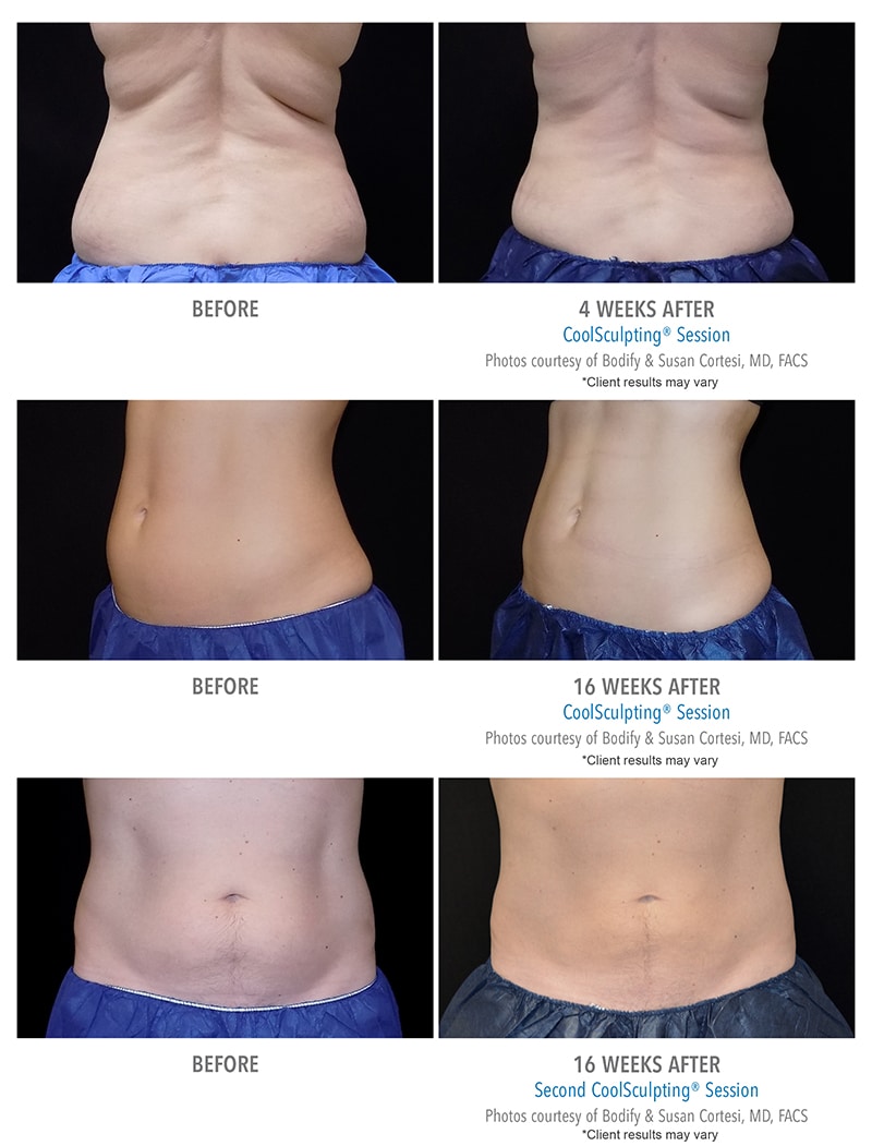 Coolsculpting Before After Photos Client Results Bodify Arizona