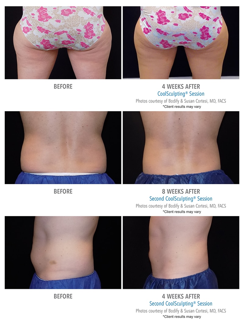 Coolsculpting Before And After Photos Client Results Bodify Arizona 1136