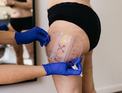 CoolSculpting Elite for Thighs: Sculpting Your Legs with Precision