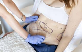 why should i consider coolsculpting elite