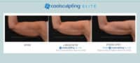 Coolsculpting Before After Photos Client Results Bodify Arizona