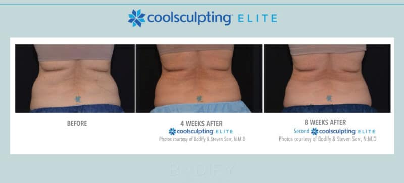 Coolsculpting Before And After Photos Client Results Bodify Arizona 2963