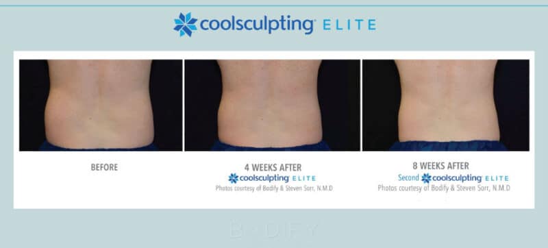 Coolsculpting Before And After Photos Client Results Bodify Arizona 3260