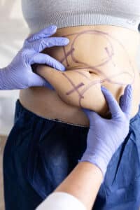 Image about CoolSculpting for Stubborn Fat: Targeting Those Hard-to-lose Areas by Bodify Call Today