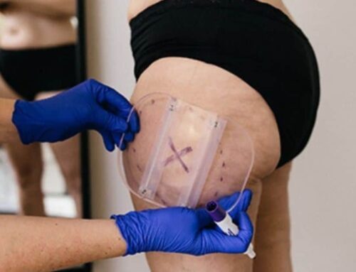 CoolSculpting Elite for Thighs: Sculpting Your Legs with Precision