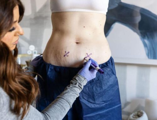 How Is CoolSculpting Elite at Bodify Tailored for Different Body Types?