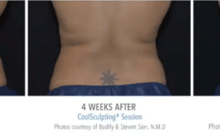 Learn how CoolSculpting reduces bra fat and back bulges. Contact our Scottsdale location at 480-530-0030 to schedule your consultation today.