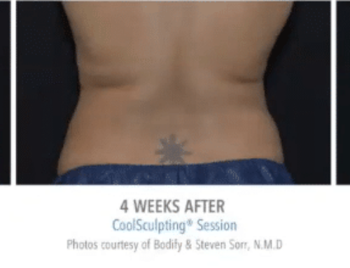 How Can CoolSculpting Address Bra Fat and Bulges on the Back?