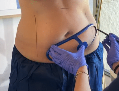 Why CoolSculpting Is Perfect for Slimming Down Before Vacation