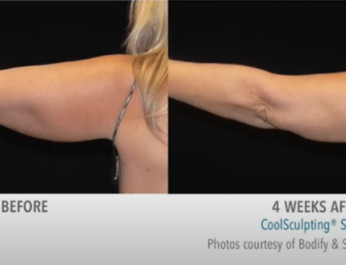 Is CoolSculpting Effective for Reducing Fat in Specific Areas Like the Thighs or Arms?